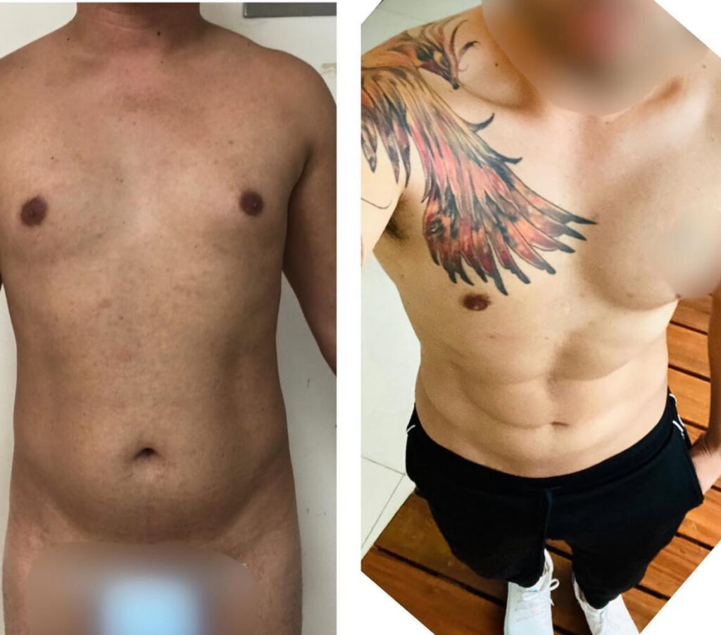 Daddy makeover - Before and after. Six pack 360 surgery results.